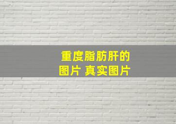 重度脂肪肝的图片 真实图片